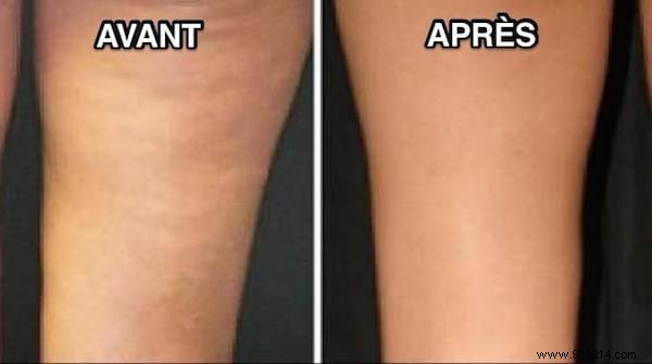 16 Proven Natural Remedies to Reduce Cellulite Effectively