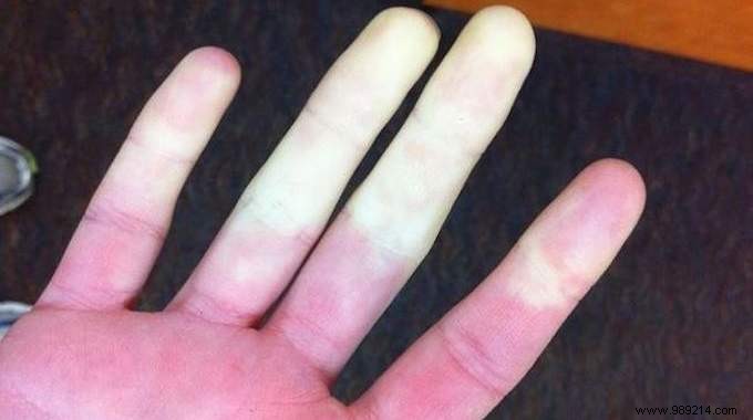 Effective Essential Oil Remedy for Raynaud s Disease: Relieve Numb, Cold Extremities Fast