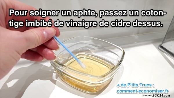 Natural Canker Sore Relief: Apple Cider Vinegar as a Simple, Effective Alternative