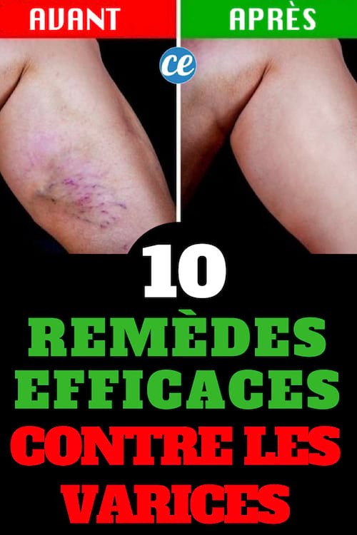 10 Natural Remedies to Reduce Varicose Vein Symptoms and Improve Circulation