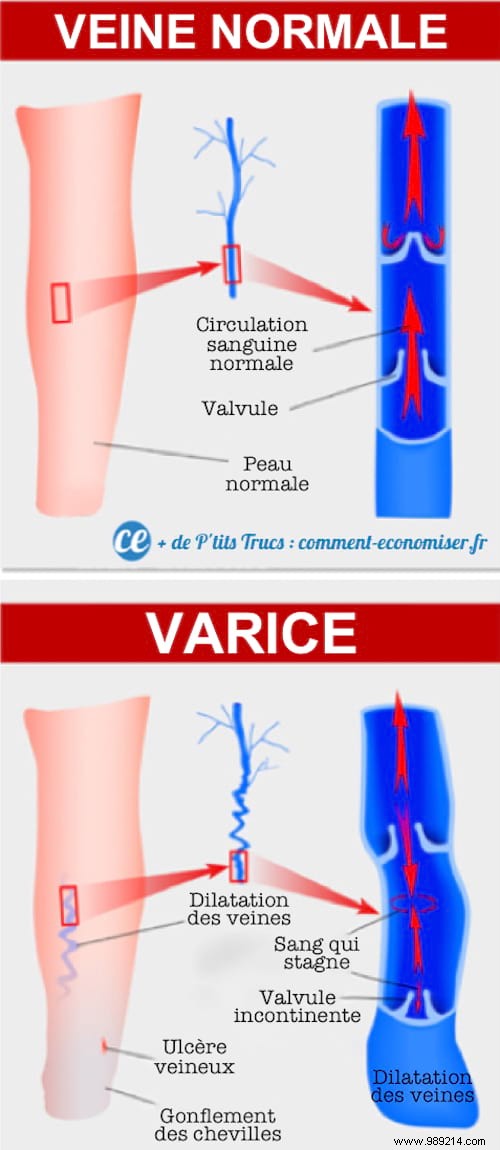 10 Natural Remedies to Reduce Varicose Vein Symptoms and Improve Circulation