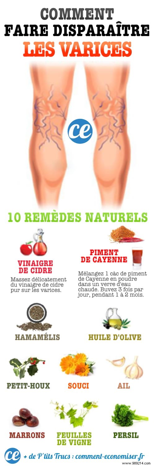 10 Natural Remedies to Reduce Varicose Vein Symptoms and Improve Circulation