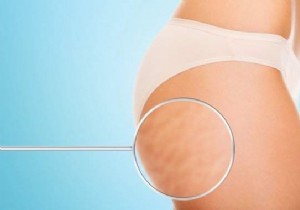 6 Targeted Exercises to Help Reduce Cellulite in 2 Weeks