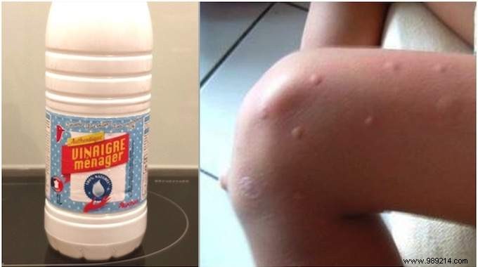 Soothe Itchy Insect Bites Fast with White Vinegar: Proven Natural Remedy