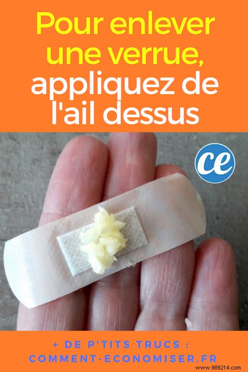 Proven Garlic Remedy for Fast Wart Removal: A Time-Tested Natural Approach