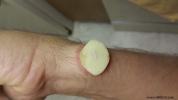 Proven Garlic Remedy for Fast Wart Removal: A Time-Tested Natural Approach