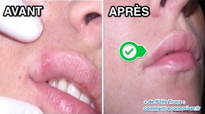 Fast Cold Sore Relief: Baking Soda Paste Home Remedy That Works