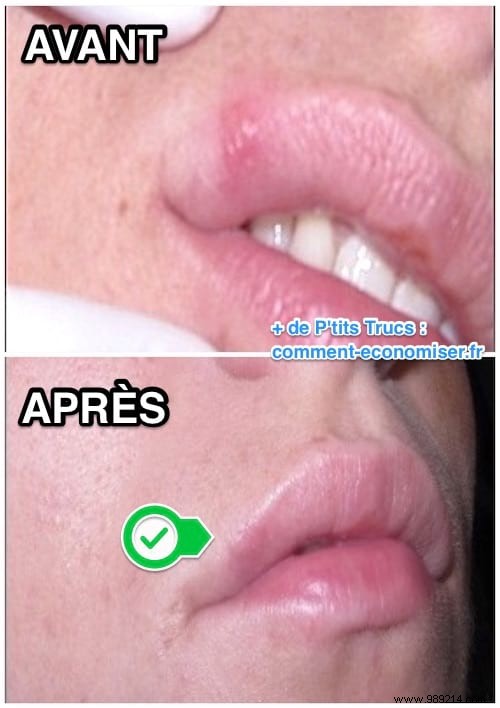 Fast Cold Sore Relief: Baking Soda Paste Home Remedy That Works