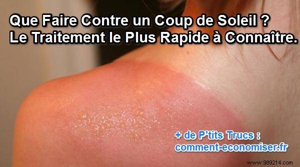 Soothe Sunburn Fast: White Vinegar Ice Cubes and Proven Home Remedies