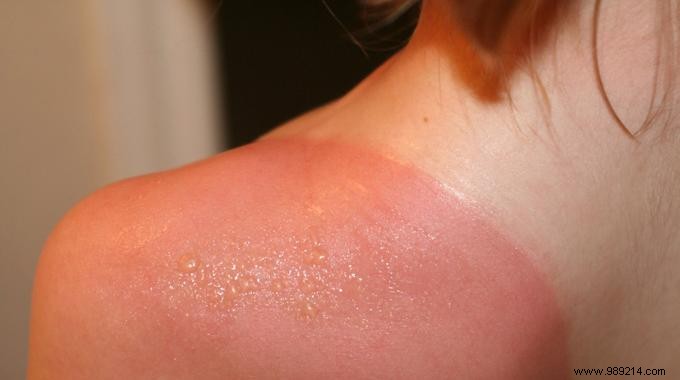 Soothe Sunburn Fast: White Vinegar Ice Cubes and Proven Home Remedies