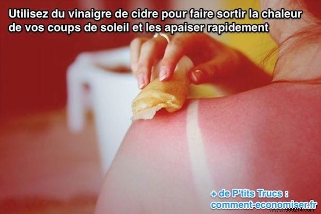 Soothe Sunburn Pain Fast: Proven Apple Cider Vinegar Remedy
