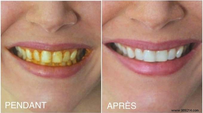 How to Whiten Yellow Teeth Naturally with Turmeric: A Proven Home Remedy