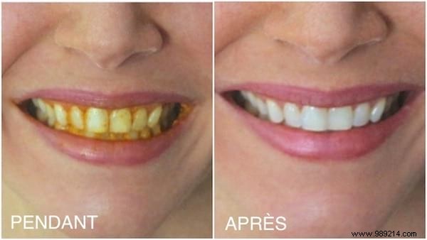 How to Whiten Yellow Teeth Naturally with Turmeric: A Proven Home Remedy