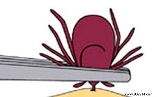 Safely Remove Ticks: The Expert-Recommended Method to Avoid Disease Risk