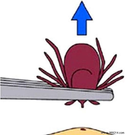 Safely Remove Ticks: The Expert-Recommended Method to Avoid Disease Risk