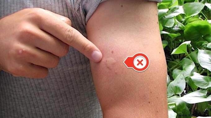 5 Proven Natural Remedies to Instantly Soothe Mosquito Bites