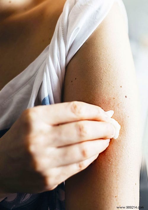 5 Proven Natural Remedies to Instantly Soothe Mosquito Bites
