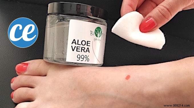 Heal Painful Burst Blisters Fast with Aloe Vera: A Proven Natural Remedy