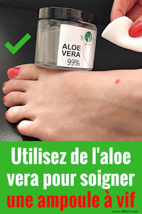 Heal Painful Burst Blisters Fast with Aloe Vera: A Proven Natural Remedy