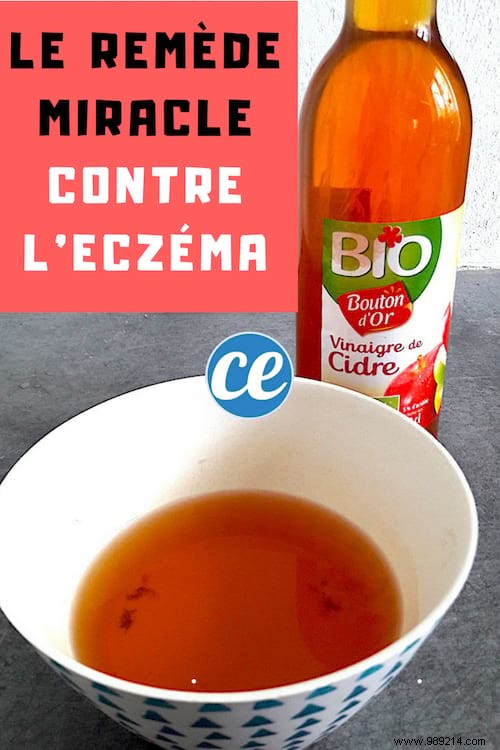 Relieve Eczema Itching Naturally: A Nurse s Proven Apple Cider Vinegar Remedy