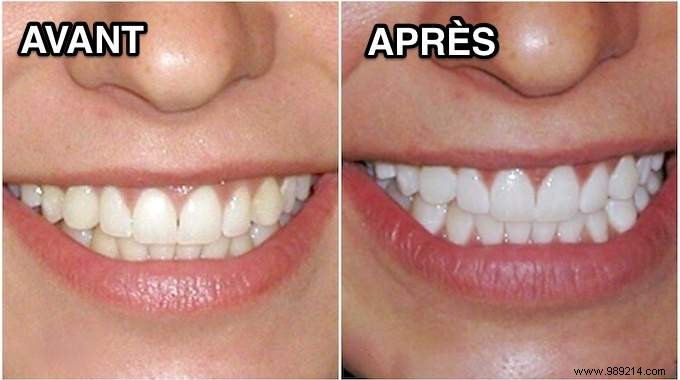 3 Proven Natural Remedies for Whiter Teeth: Lemon and Baking Soda Guide