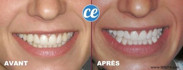 3 Proven Natural Remedies for Whiter Teeth: Lemon and Baking Soda Guide