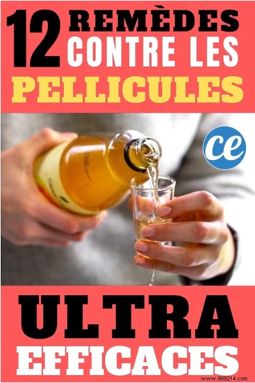 12 Proven Natural Remedies to Eliminate Dandruff Effectively