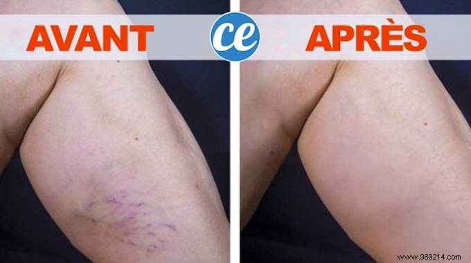 Time-Tested Grandmother s Remedy for Varicose Veins: Apple Cider Vinegar and Honey