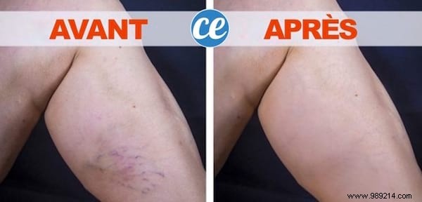 Time-Tested Grandmother s Remedy for Varicose Veins: Apple Cider Vinegar and Honey