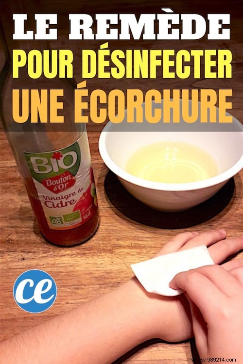 Heal Minor Wounds Naturally: Disinfect with Apple Cider Vinegar – No Antiseptic Needed
