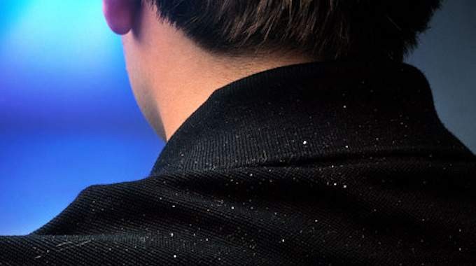 Eliminate Dandruff Naturally: Proven Apple Cider Vinegar Rinse