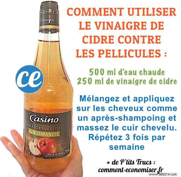 Eliminate Dandruff Naturally: Proven Apple Cider Vinegar Rinse