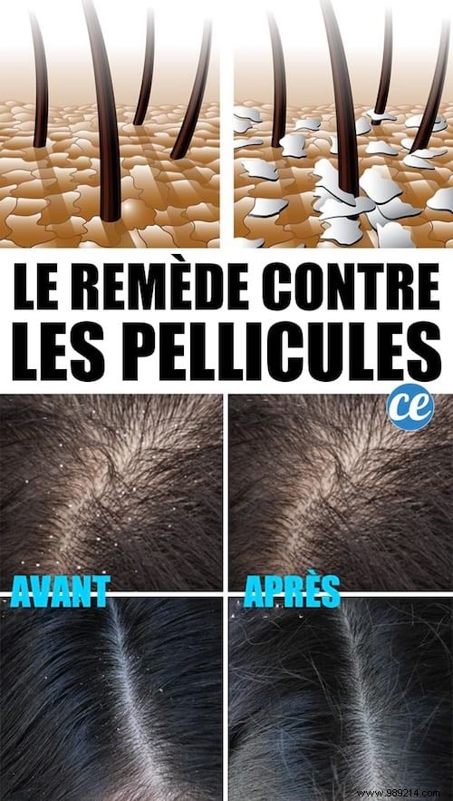 Eliminate Dandruff Naturally: Proven Apple Cider Vinegar Rinse