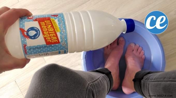 Eliminate Foot Fungus Naturally: My Proven Vinegar Foot Soak Remedy