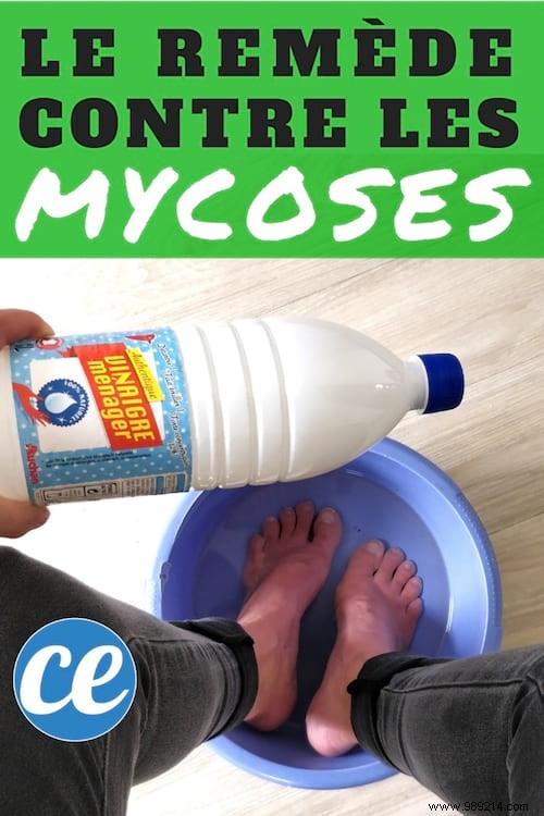 Eliminate Foot Fungus Naturally: My Proven Vinegar Foot Soak Remedy
