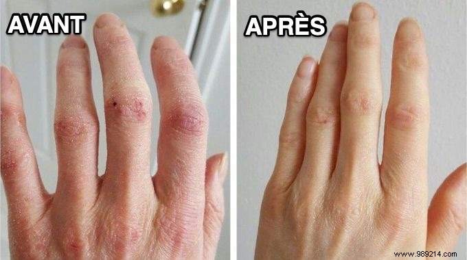 6 Time-Tested Grandmother s Remedies for Dry, Cracked Hands