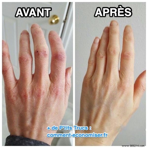 6 Time-Tested Grandmother s Remedies for Dry, Cracked Hands