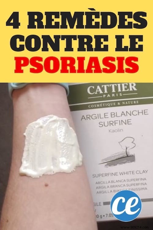 4 Proven White Clay Remedies for Soothing Psoriasis