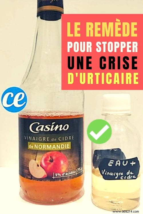 Fast Hives Relief: Simple Cider Vinegar Lotion to Stop Itching