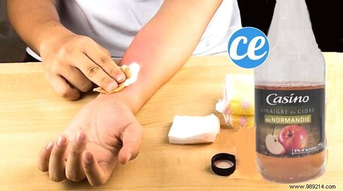 Fast Hives Relief: Simple Cider Vinegar Lotion to Stop Itching