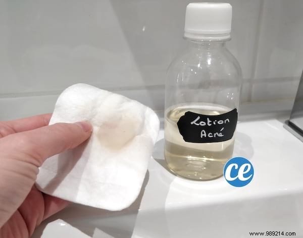 Clear Acne Naturally: The Power of Diluted Apple Cider Vinegar