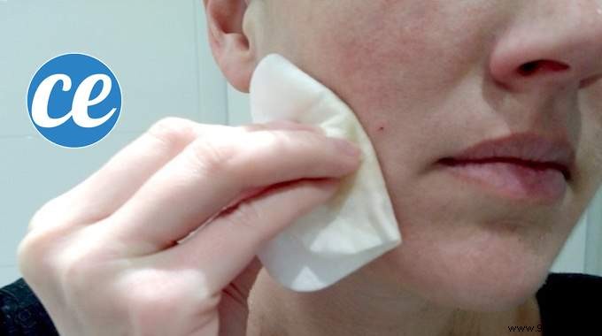 Clear Acne Naturally: The Power of Diluted Apple Cider Vinegar