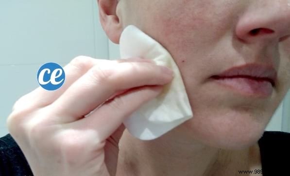 Clear Acne Naturally: The Power of Diluted Apple Cider Vinegar