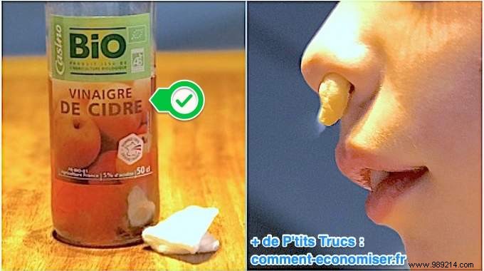 Stop Nosebleeds Fast: A Pharmacist s Proven Apple Cider Vinegar Remedy