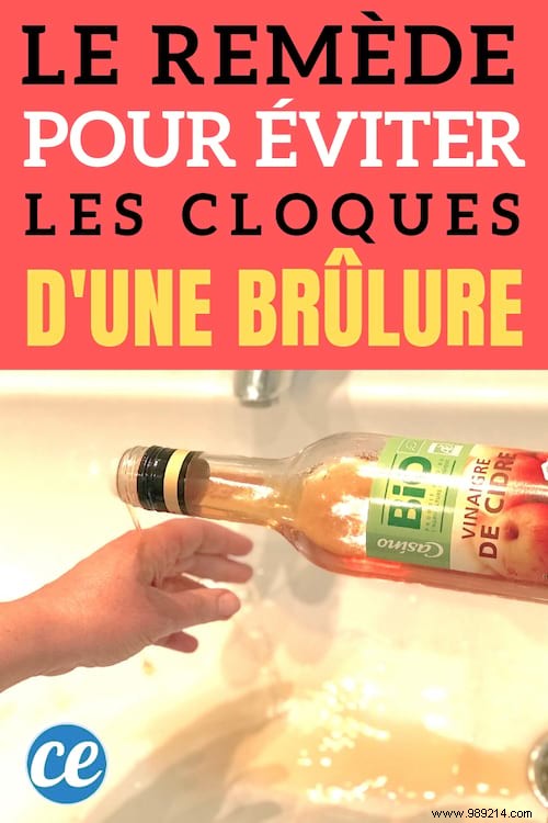 Nurse-Approved Remedy: Relieve Minor Burns and Prevent Blisters with This Simple Trick