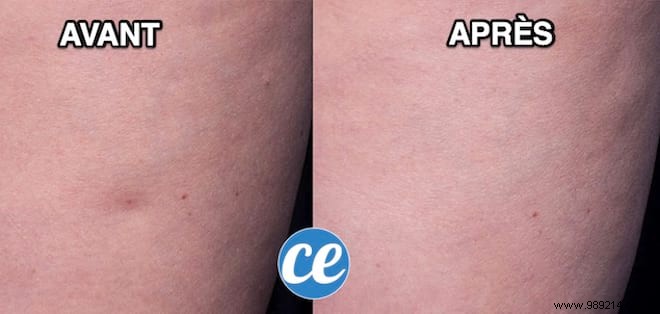 Grandma s Time-Tested Remedy: Smooth Orange Peel Skin Naturally and Affordably