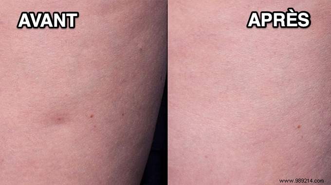 Grandma s Time-Tested Remedy: Smooth Orange Peel Skin Naturally and Affordably