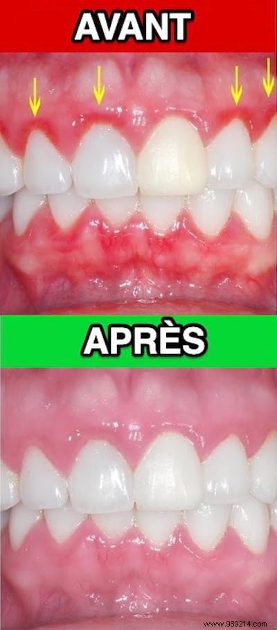 Effective Natural Remedy for Gingivitis: Apple Cider Vinegar Mouthwash for Fast Pain Relief