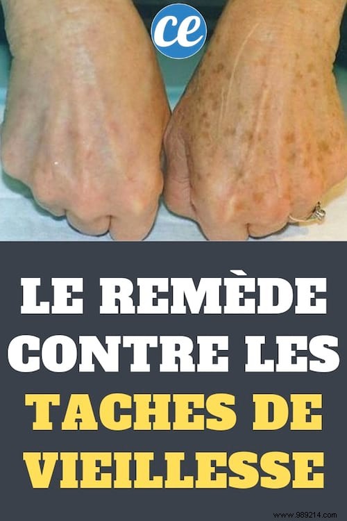 Fade Age Spots Naturally: A Proven Magnesium Chloride Treatment