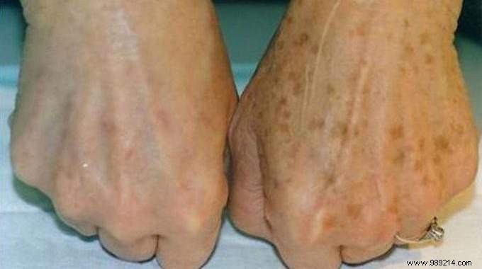 Fade Age Spots Naturally: A Proven Magnesium Chloride Treatment